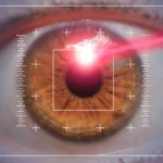 LASIK Surgery Age Limit